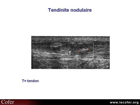 Tendinite du tendon d'Achille, échographie