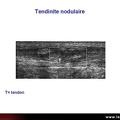 Tendinite du tendon d'Achille, échographie