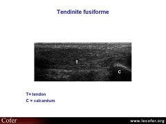 Tendinite du tendon d'Achille, échographie