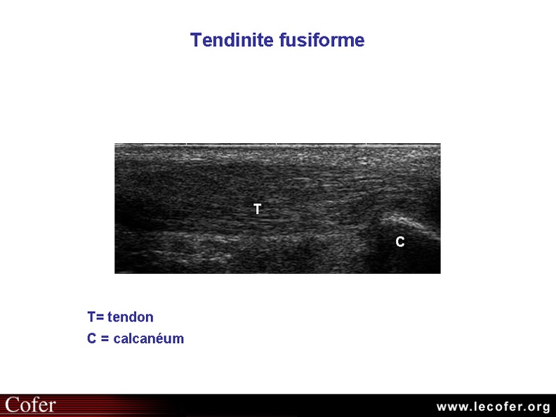 Tendinite du tendon d'Achille : tendinite fusiforme. 010301016.jpg