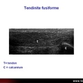 Tendinite du tendon d'Achille, échographie