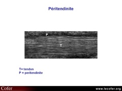 Tendinite du tendon d'Achille, échographie