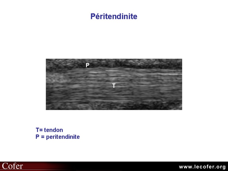 Tendinite du tendon d'Achille, échographie