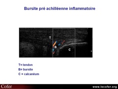 Bursite inflammatoire, tendon d'Achille, échographie