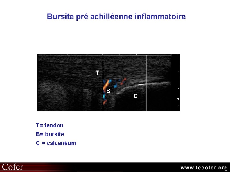 Bursite pré-achilléenne inflammatoire en mode Doppler puissance au cours d'un rhumatisme psoriasique (coupe longitudinale). 010301022.jpg