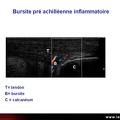 Bursite inflammatoire, tendon d'Achille, échographie