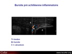 Bursite inflammatoire, tendon d'Achille, échographie