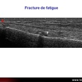 Fracture de fatigue, échographie