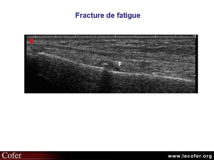 Fracture de fatigue, échographie