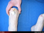 Polyarthrite rhumatoïde, PR débutante, PR : recherche de la douleur des avant-pieds ; squeeze test (compression latérale du pied