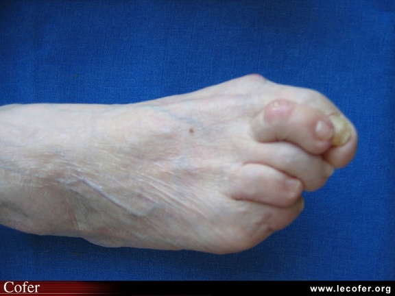 Polyarthrite rhumatoïde, PR ; atteinte de l’avant-pied, atteinte du pied ; avant-pied triangulaire