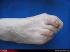 Polyarthrite rhumatoïde, PR ; atteinte de l’avant-pied, atteinte du pied ; avant-pied triangulaire