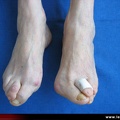 Polyarthrite rhumatoïde, PR ; atteinte de l’avant-pied ; orteils en griffe