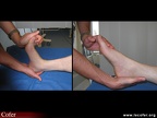 Polyarthrite rhumatoïde, PR ; atteinte de l’arrière-pied ; étude de la mobilité de la tibio-tarsienne