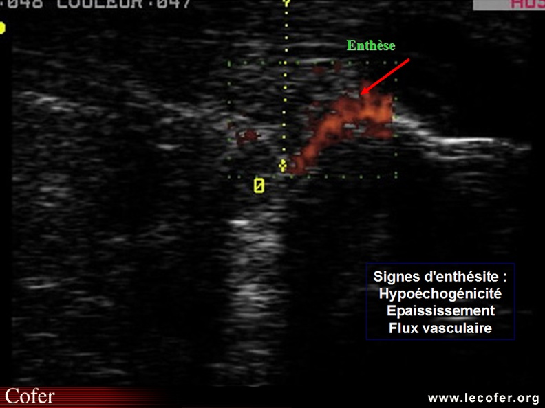 Images échographiques / échographie / enthèse d'Achille