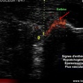 Images échographiques / échographie / enthèse d'Achille