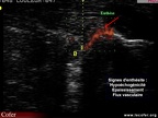Images échographiques / échographie / enthèse d'Achille