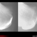 Spondylarthrite ankylosante / SpA / pelvispondylite rhumatismale / spondylarthropathie : enthésites calcanéennes