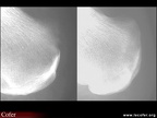 Spondylarthrite ankylosante / SpA / pelvispondylite rhumatismale / spondylarthropathie : enthésites calcanéennes