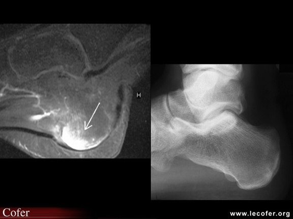 Spondylarthrite ankylosante / SpA / pelvispondylite rhumatismale / spondylarthropathie