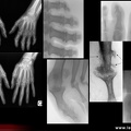 Rhumatisme psoriasique : différents aspects radiologiques de l’atteinte des doigts ou des orteils