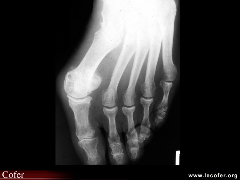 Hallux valgus