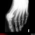 Hallux valgus