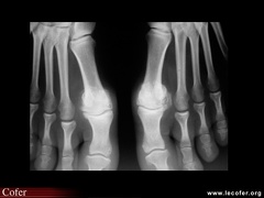 Hallux rigidus