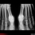 Hallux rigidus