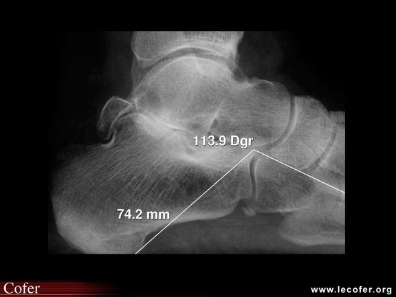 Arthrose du médiopied