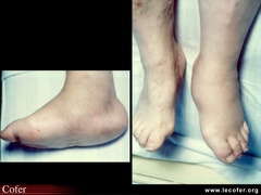 Diabète : atteinte du pied