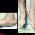 Diabète : atteinte du pied
