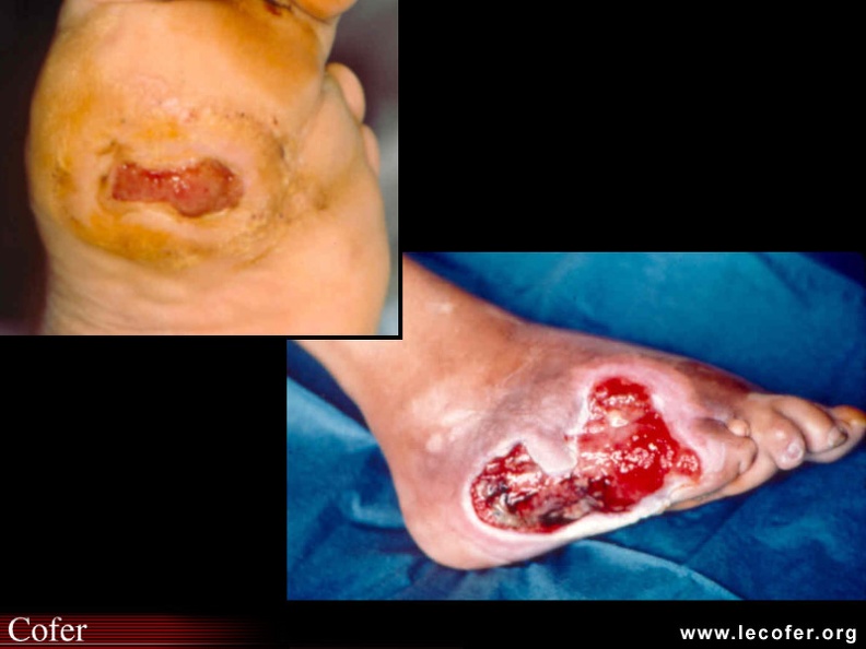 Acropathie ulcéro-mutilante diabétique : maux perforants plantaires. 090100003.jpg