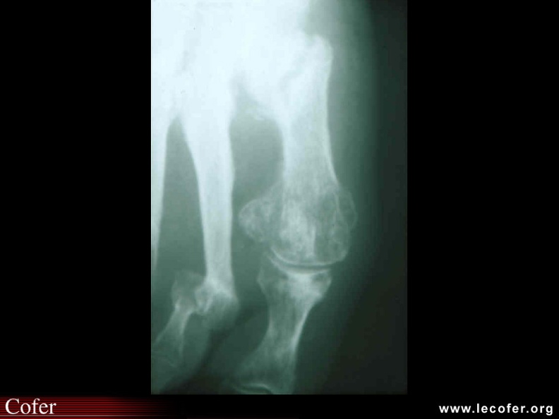 Ostéoarthropathie neurogène diabétique : fracture spontanée de la base et de la tête du premier métatarsien. 090100008.jpg
