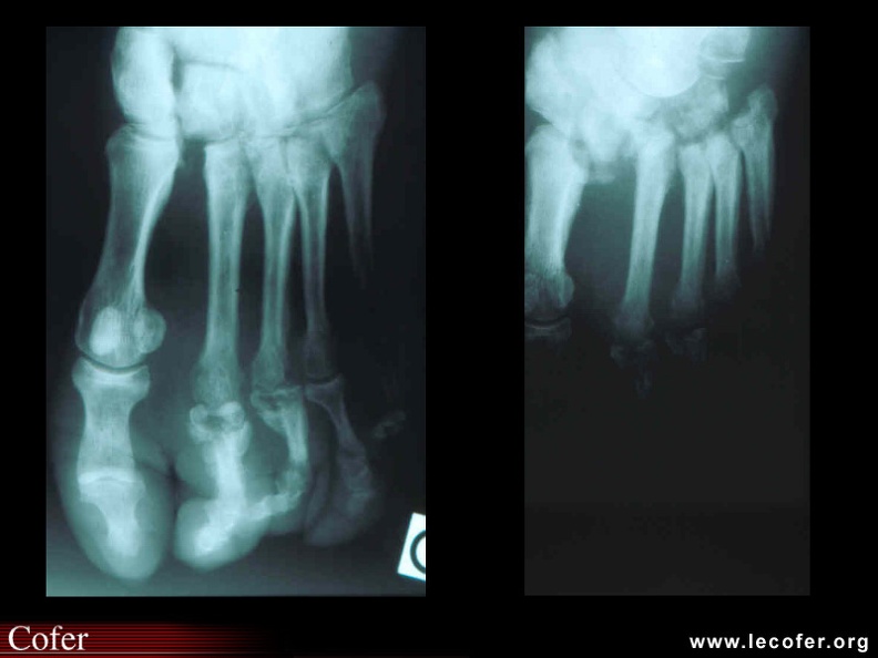 Ostéoarthropathie neurogène diabétique : dislocation de l'articulation de Lisfranc et destruction des métatarso-phalangiennes des 2e et 3e rayons. Évolution à quelques mois d'intervalle. 090100009.jpg