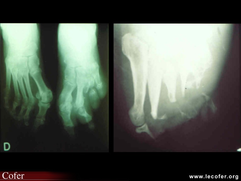 Ostéoarthropathie neurogène diabétique chez deux malades différents avec, dans un cas une amputation des 3 derniers rayons et, dans l'autre cas une destruction des métatarsiens (image en sucre d'orge à demi-sucré). 090100011.jpg