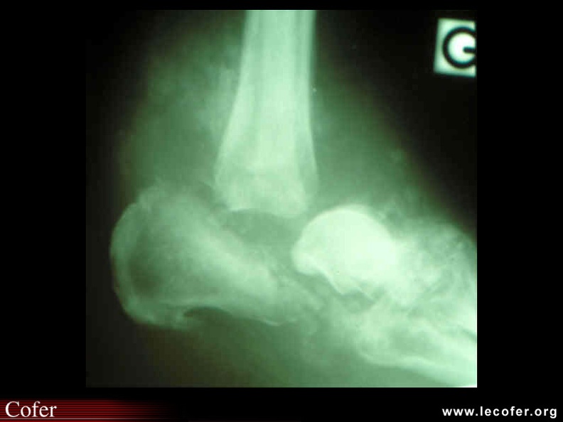 Pied diabétique : ostéoarthropathie neurogène : dislocation de l'arrière-pied. 090100013.jpg