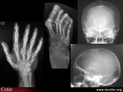 Pseudohypoparathyroïdie