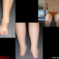 Oligoarthrite juvénile : atteinte du pied et du poignet