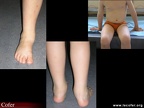 Oligoarthrite juvénile : atteinte du pied et du poignet