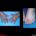 Spondylarthropathie juvénile : doigts et orteils en saucisse. SPA Spondylarthrite Pédiatrie
