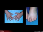 Spondylarthropathie juvénile : doigts et orteils en saucisse. SPA Spondylarthrite Pédiatrie
