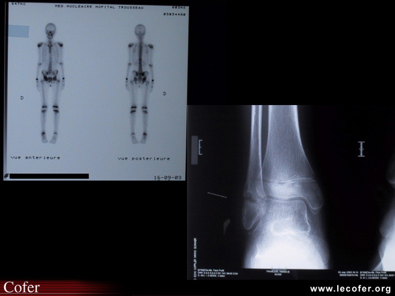 Ostéite chronique récurrente multifocale : la scintigraphie objective 3 foyers de fixation : cheville droite, cotyle droit et sacro-iliaque droite. La radiographie de la cheville droite montre un élargissement du cartilage de conjugaison du péroné avec ostéosclérose et condensation de l'épiphyse tibiale au contact du cartilage de conjugaison. 100002017.jpg