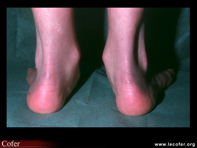 Pied plat valgus. 110001004.jpg