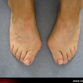 Hallux valgus