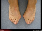 Hallux valgus