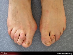 Hallux valgus avec syndrome du deuxième rayon