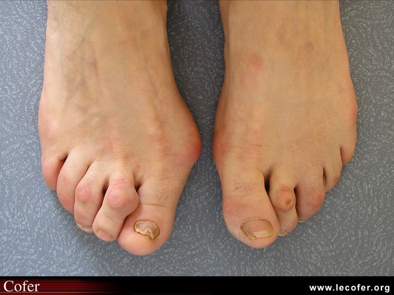 Hallux valgus avec syndrome du deuxième rayon. 110001019.jpg