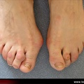 Hallux valgus avec syndrome du deuxième rayon