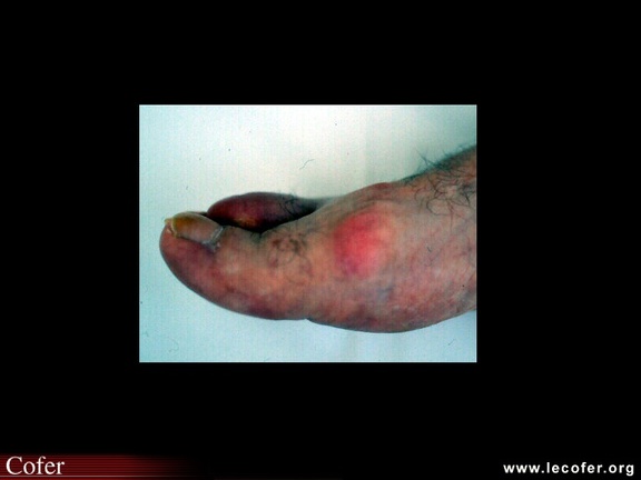 Hallux rigidus